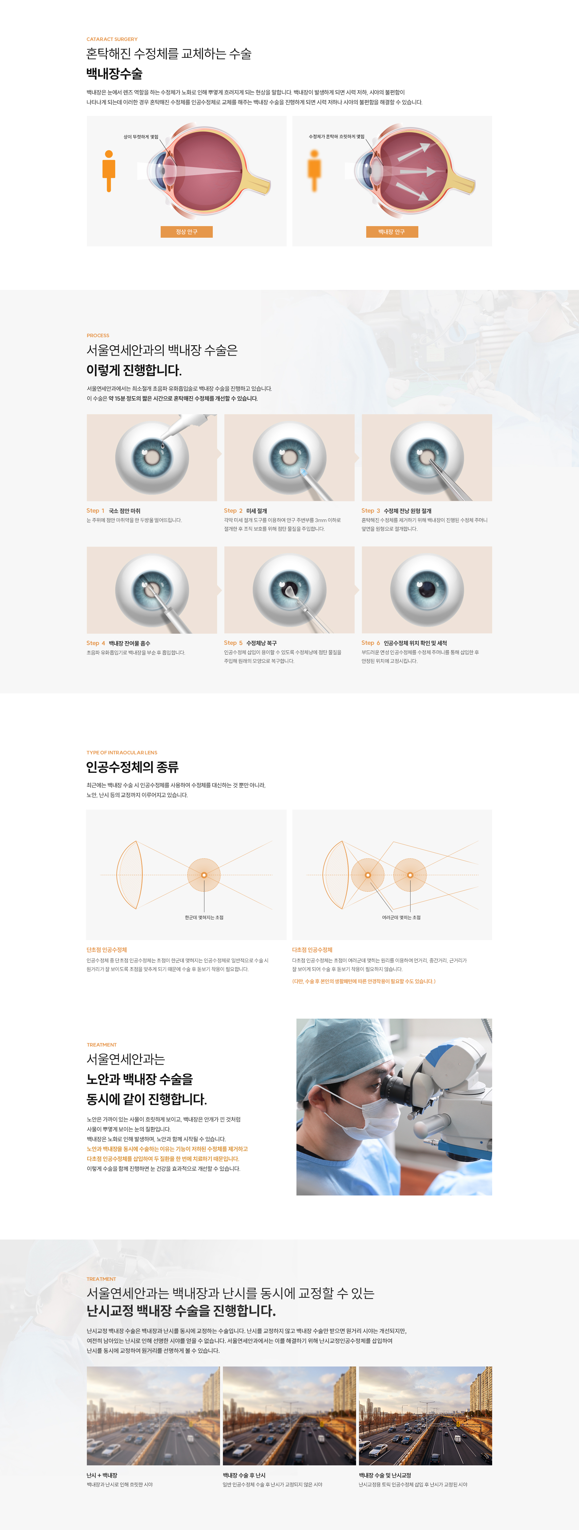 백내장수술